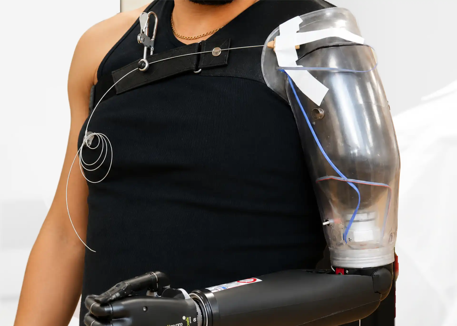 Clinical suitability assessment for below elbow and partial hand bionic prosthesis in Hyderabad