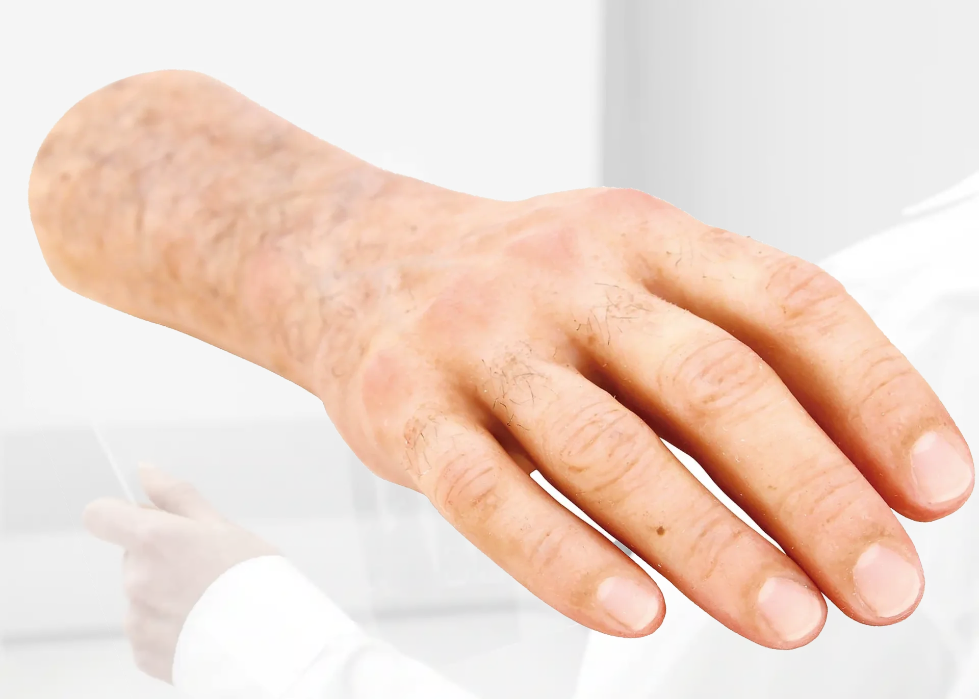 Bionic hand prosthesis assessment at DakshinRehab