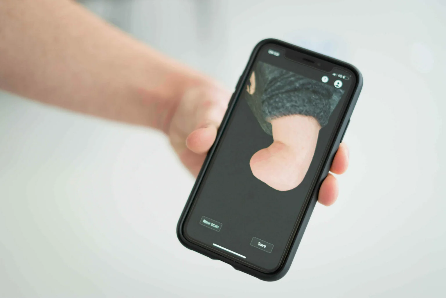 Socket design and EMG calibration for myoelectric hand prosthesis