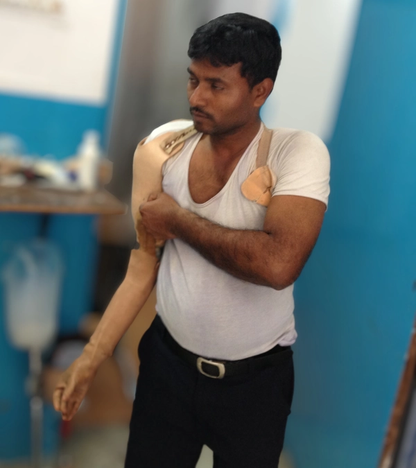 Bionic hand prosthesis in action during daily-living tasks at DakshinRehab Moosapet, Hyderabad