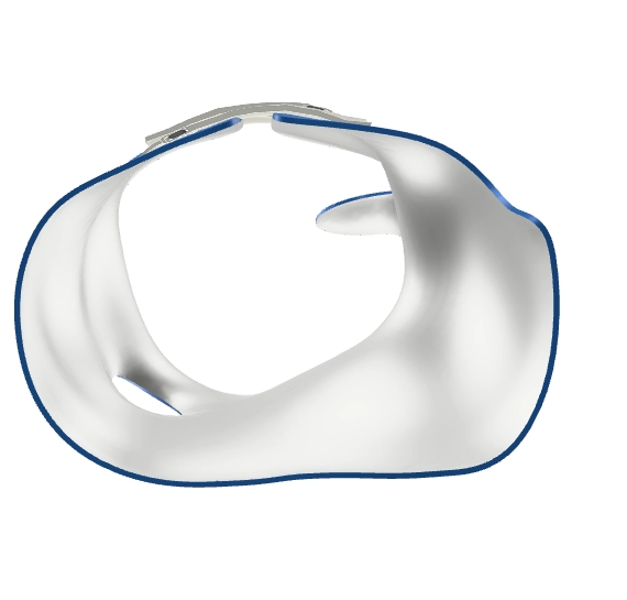 Cross-section of a Chêneau-type scoliosis brace showing pressure zones paired with expansion voids