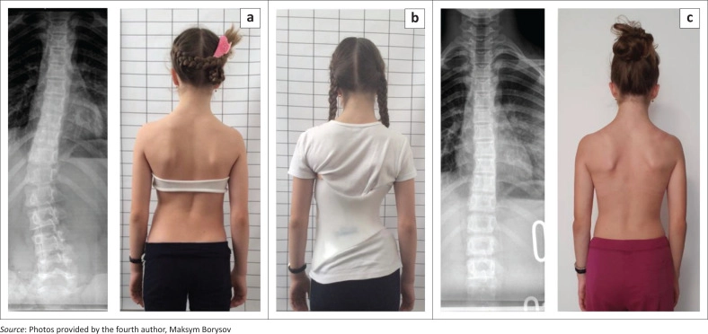 Thoracolumbar curve before bracing, strong in-brace correction in a Chêneau-style brace, and good clinical appearance after nine months