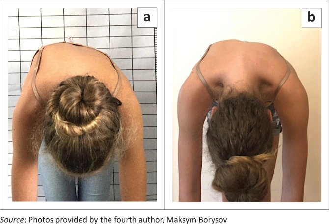 A significant rib hump before treatment and clear improvement after twelve months in a custom 3D brace