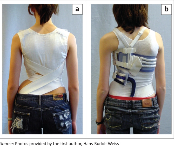 Soft scoliosis braces (SpineCor and TriaC) showing little visible corrective effect