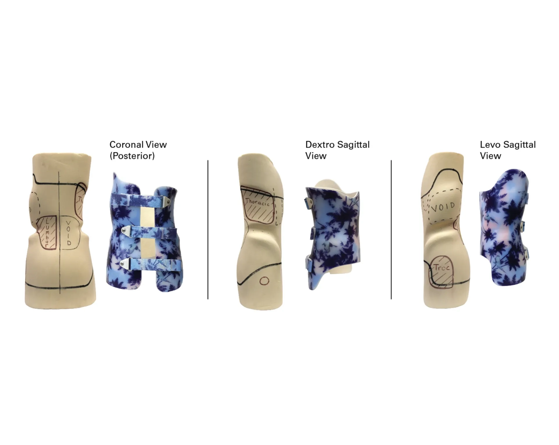 Orthotist cast rectification for a custom scoliosis brace