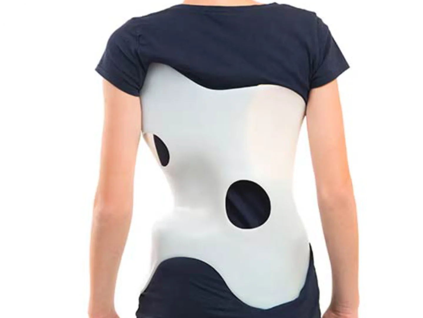 Young girl fitted with a custom scoliosis brace at DakshinRehab, Moosapet, Hyderabad