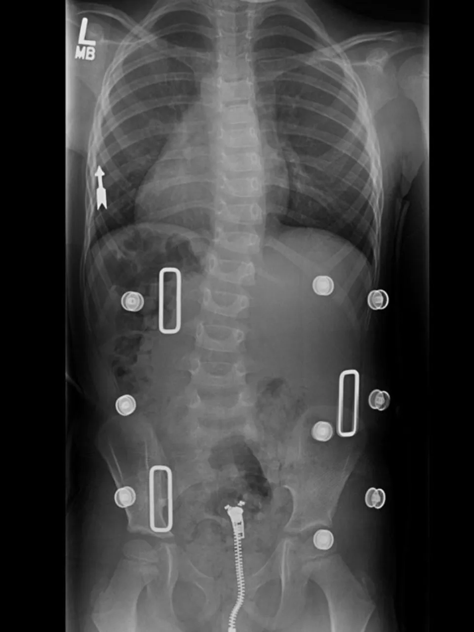 Scoliosis orthotic and bracing consultation at DakshinRehab, Moosapet, Hyderabad