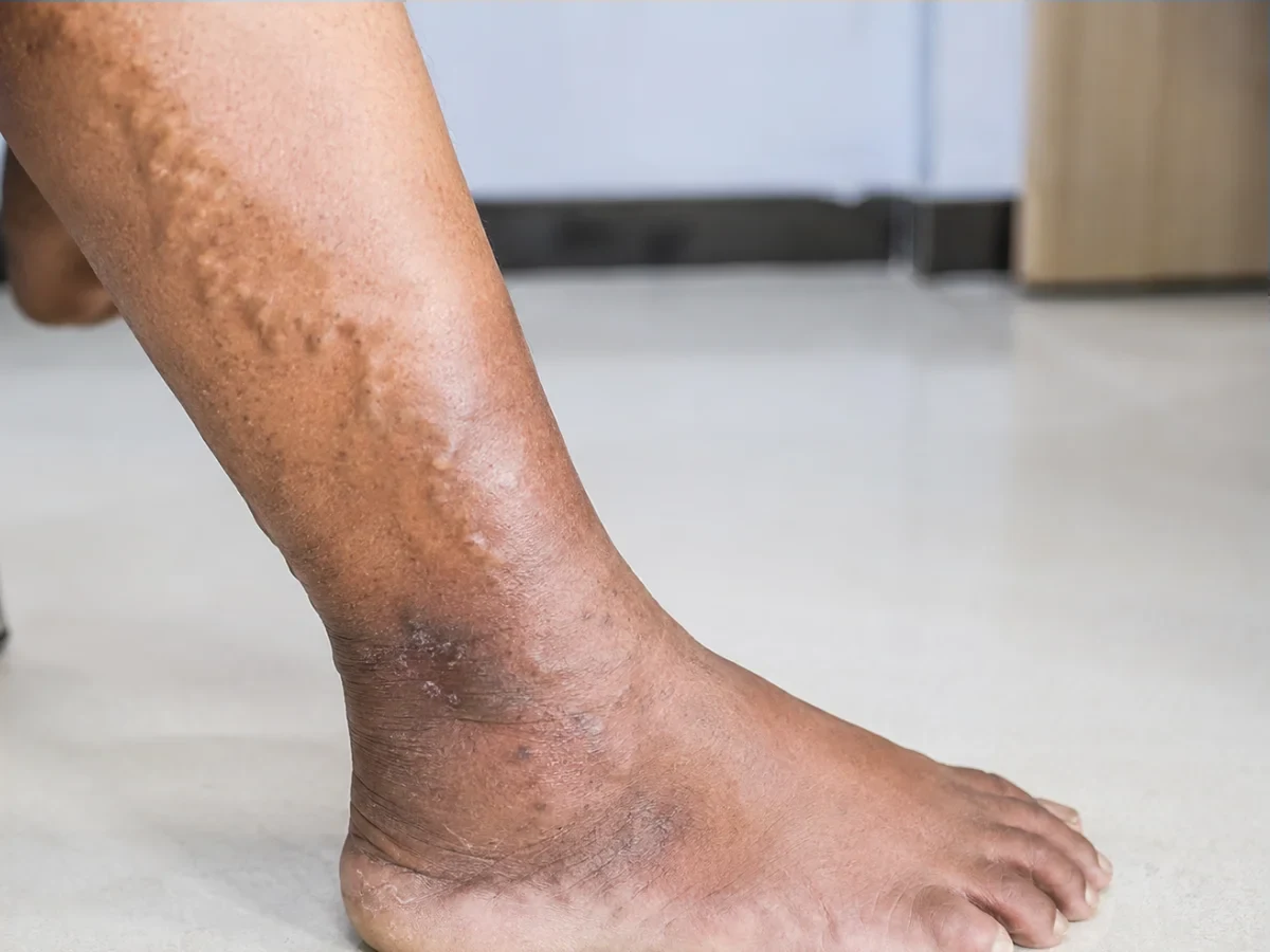 Supervised compression therapy for venous leg ulcers and stasis dermatitis at DakshinRehab Moosapet, Hyderabad