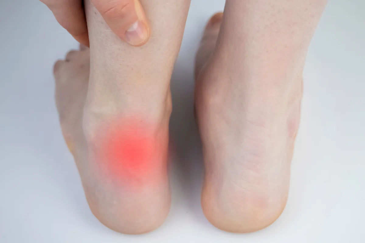 Achilles tendinopathy rehabilitation at DakshinRehab Moosapet