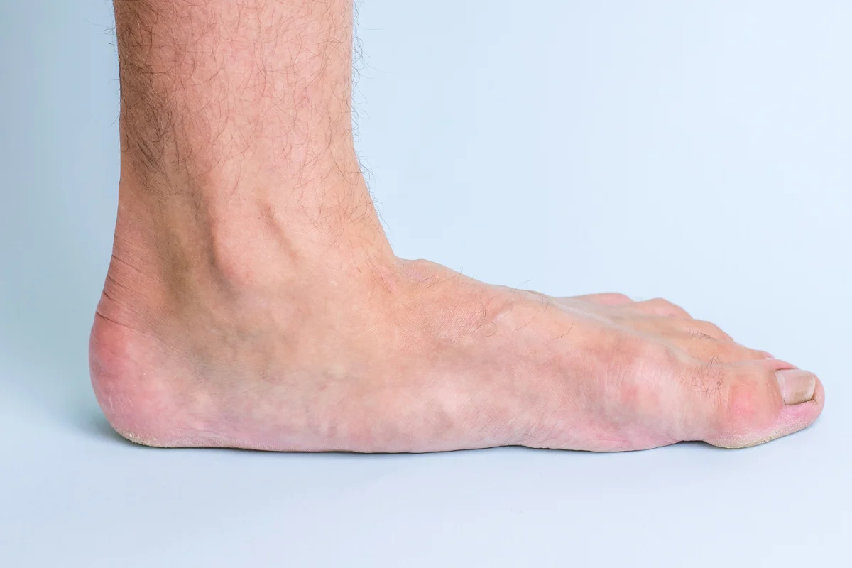 Flat feet and arch support assessment at DakshinRehab Moosapet