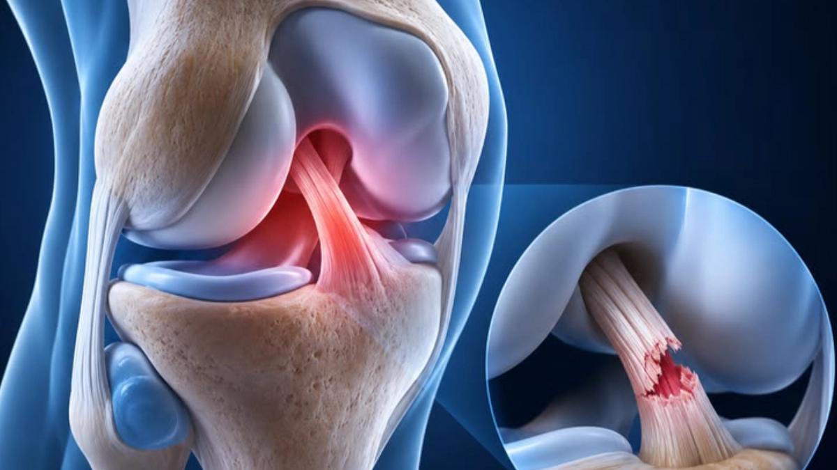 ACL, PCL & MCL Ligament Tears