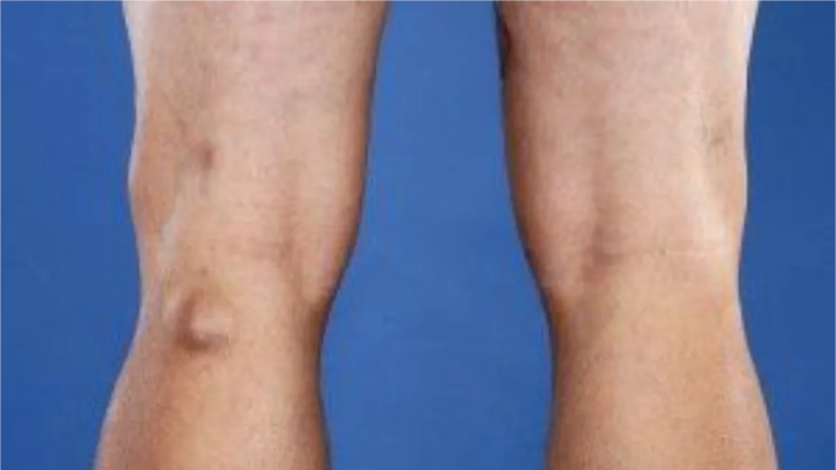 Baker's Cyst & Swelling