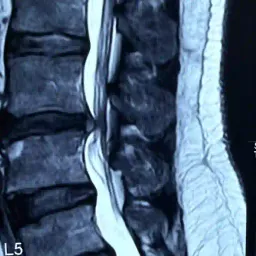 Cervical nerve root compression treatment at DakshinRehab
