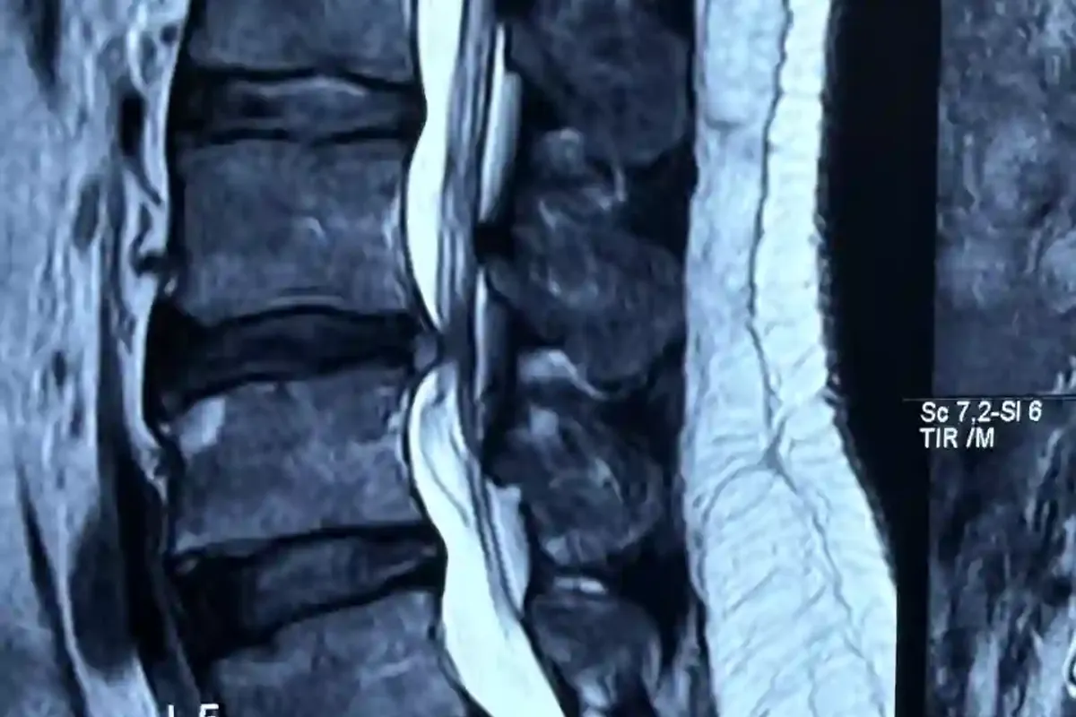Cervical disc herniation non-surgical treatment Hyderabad