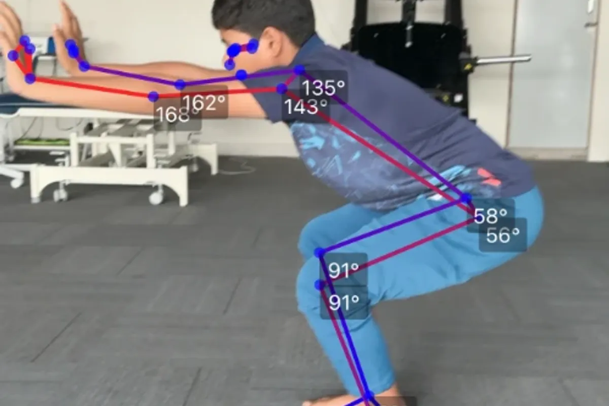 3D posture analysis for scoliosis-related posture