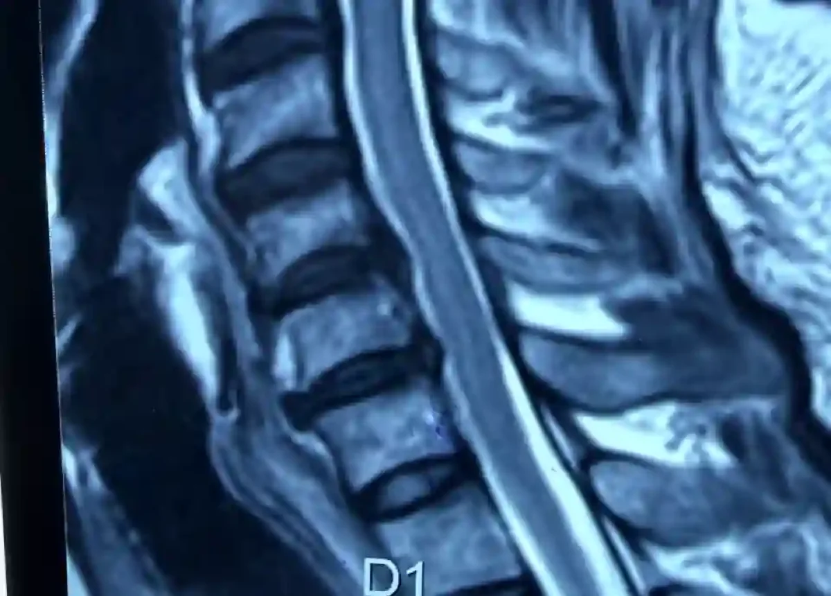 Degenerative disc disease management with spinal decompression