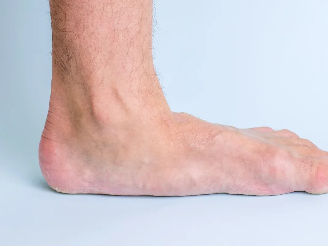 Flat feet and arch support assessment at DakshinRehab Moosapet