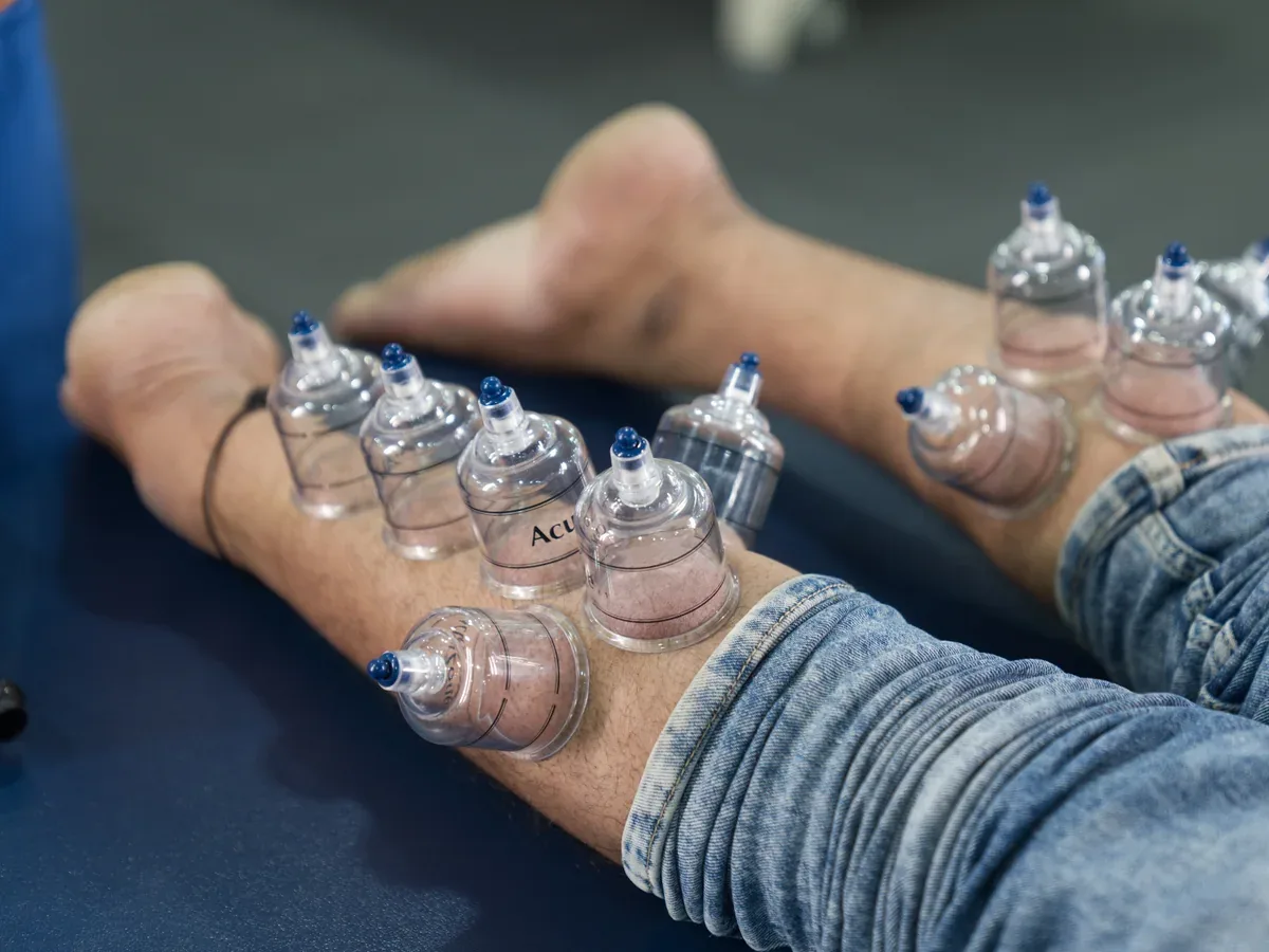 Cupping therapy for calf Achilles and plantar fascia tightness