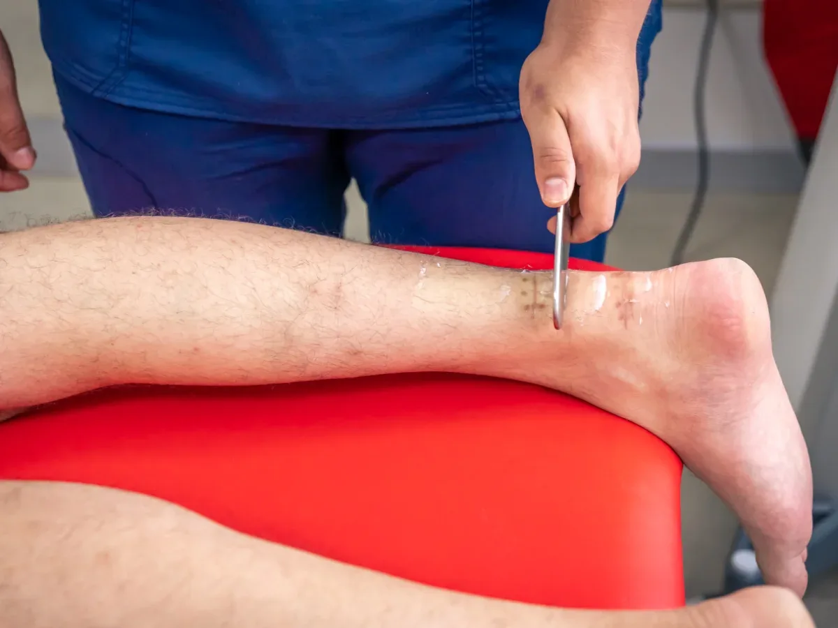 IASTM instrument assisted soft tissue mobilisation for plantar fasciitis