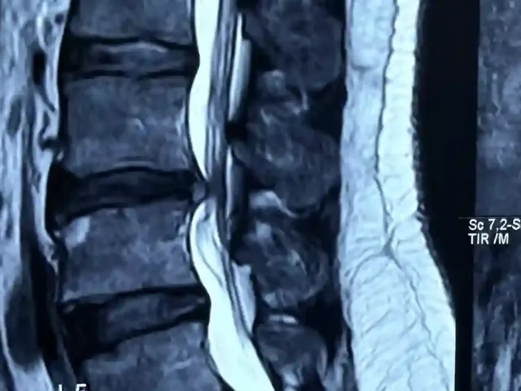 Spine surgery recovery at DakshinRehab Hyderabad