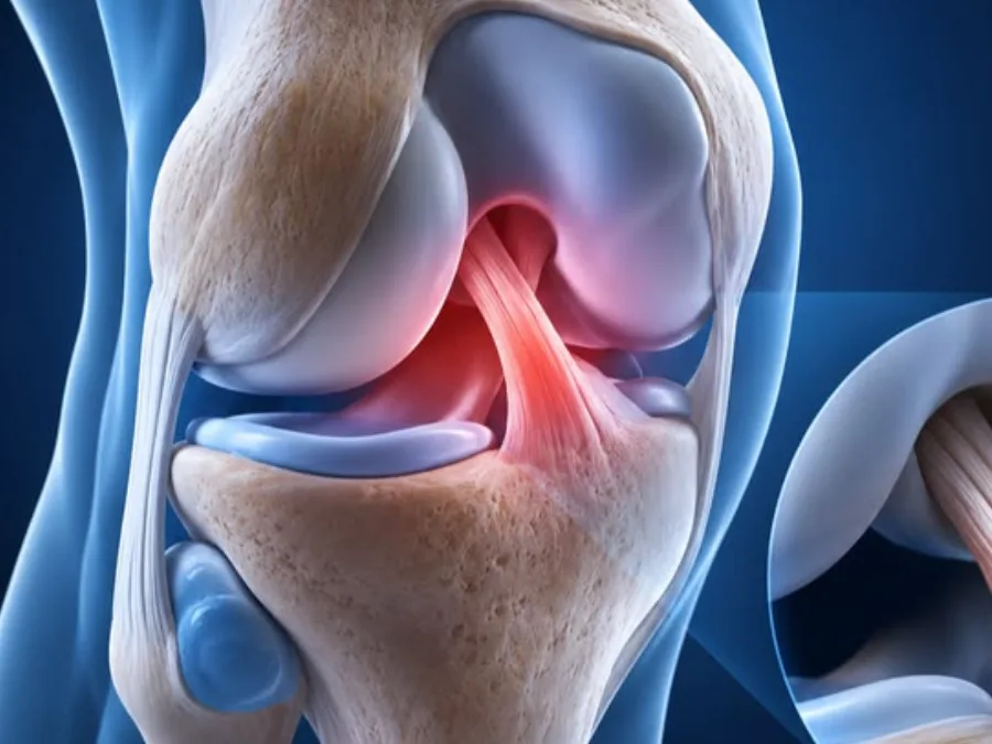 ACL, PCL & MCL Ligament Tears
