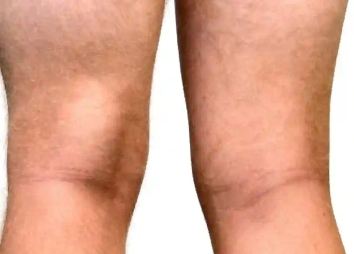 Baker's Cyst