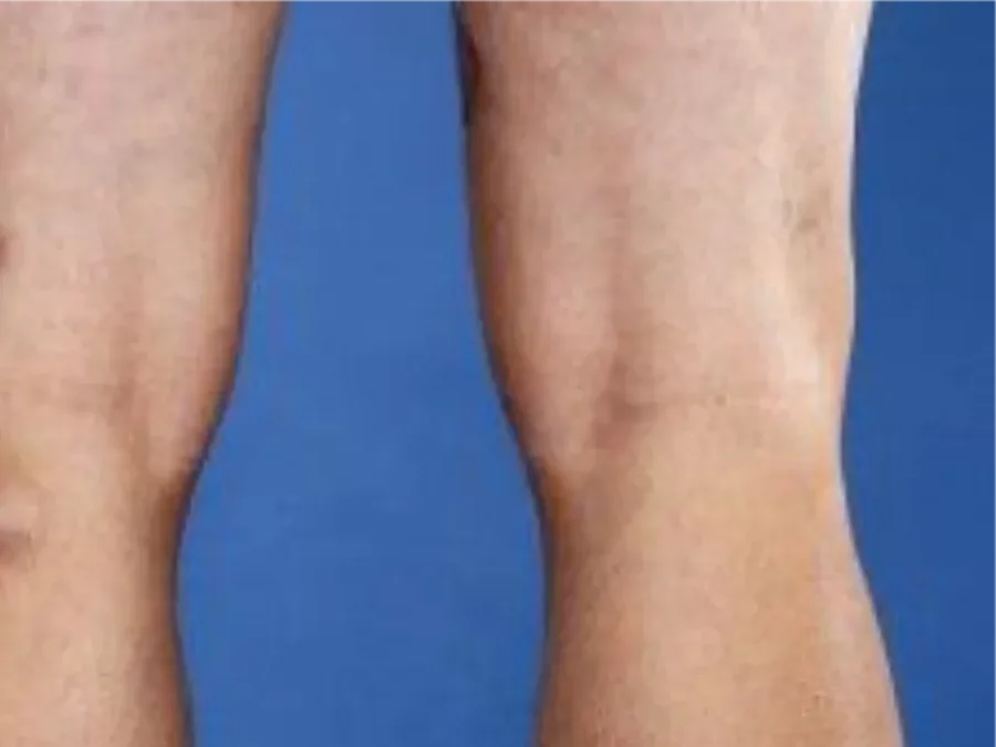 Baker's Cyst & Swelling