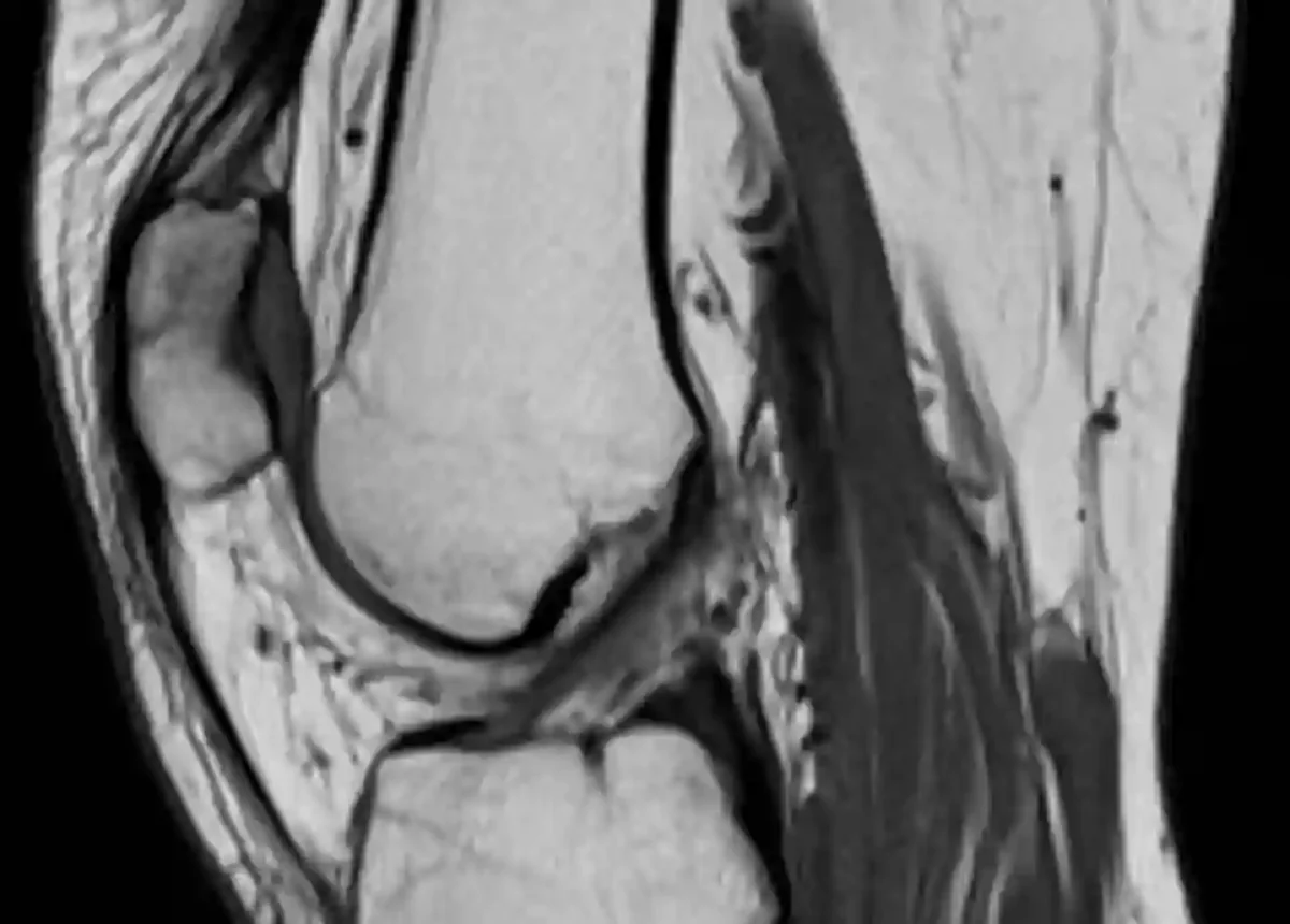 Chondromalacia Patella