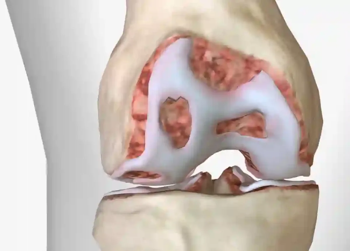 Knee Osteoarthritis