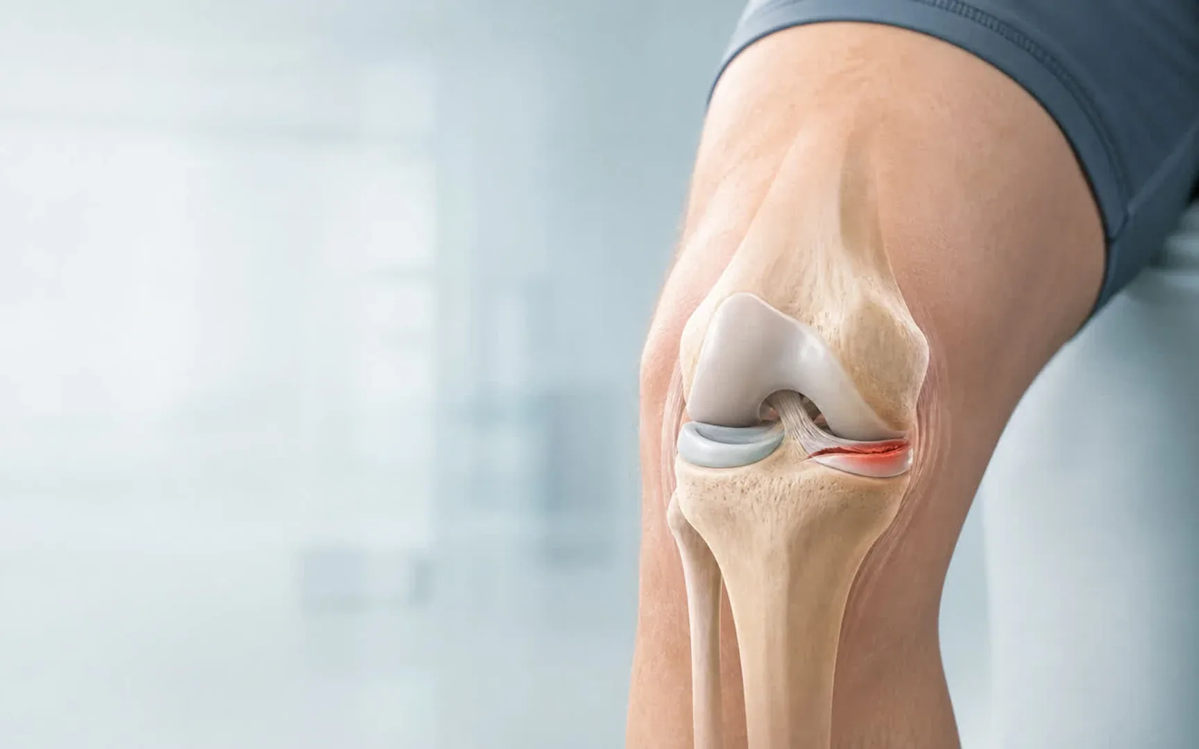 Meniscus tear illustrated in the knee joint — meniscus tear treatment at DakshinRehab, Moosapet, Hyderabad