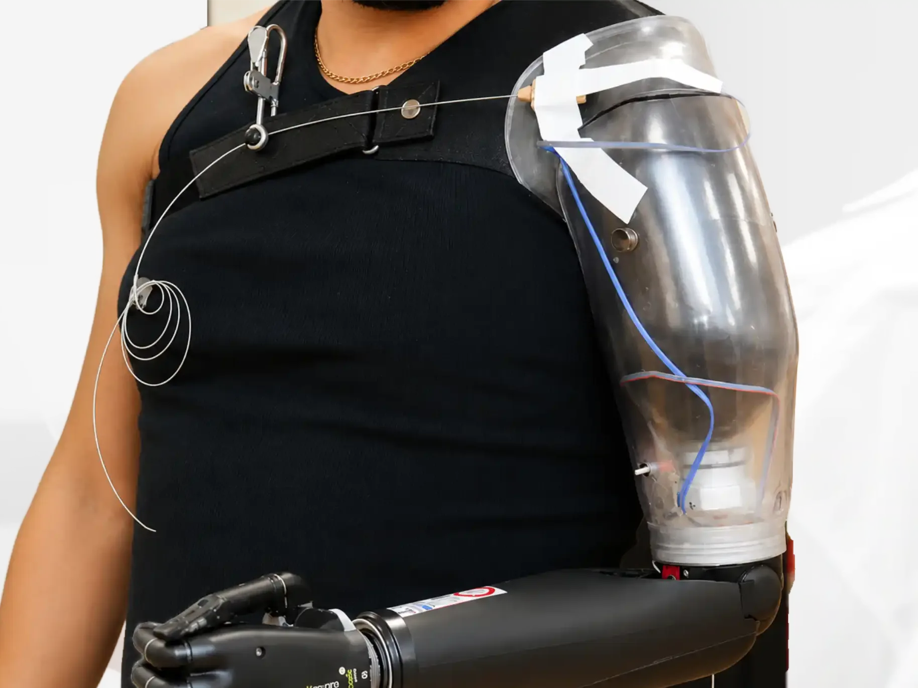 Clinical suitability assessment for below elbow and partial hand bionic prosthesis in Hyderabad