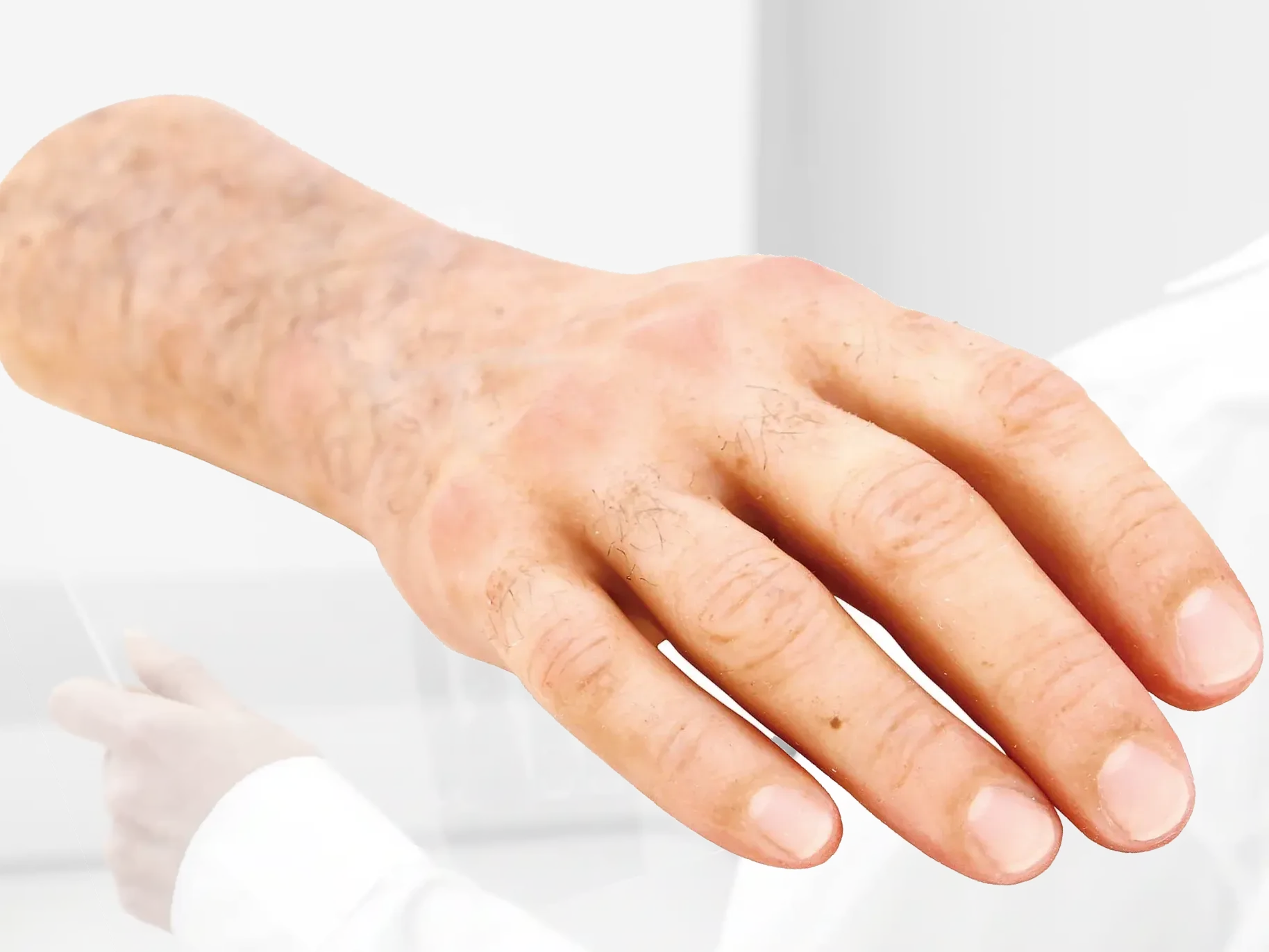 Bionic hand prosthesis assessment at DakshinRehab