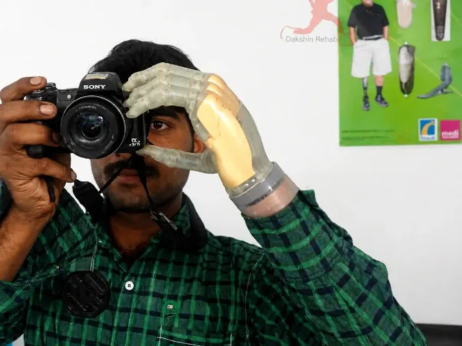 Myoelectric bionic hand and upper-limb prosthesis at DakshinRehab Moosapet