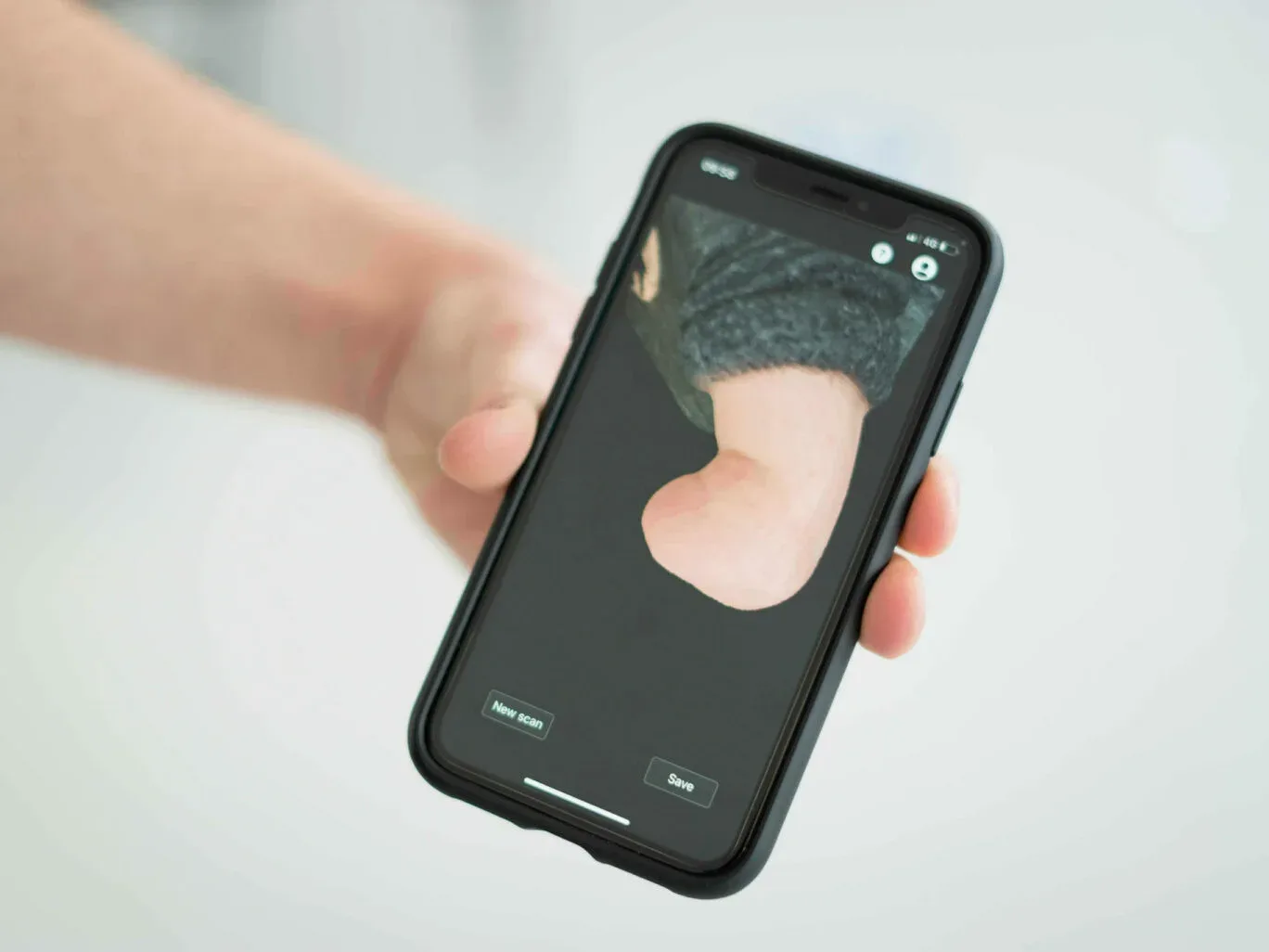 Socket design and EMG calibration for myoelectric hand prosthesis