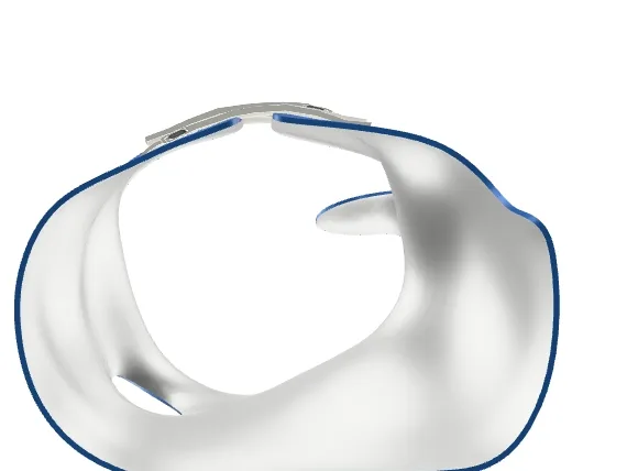 Cross-section of a Chêneau-type scoliosis brace showing pressure zones paired with expansion voids