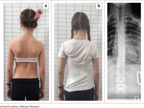 Thoracolumbar curve before bracing, strong in-brace correction in a Chêneau-style brace, and good clinical appearance after nine months
