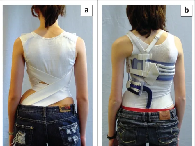 Soft scoliosis braces (SpineCor and TriaC) showing little visible corrective effect