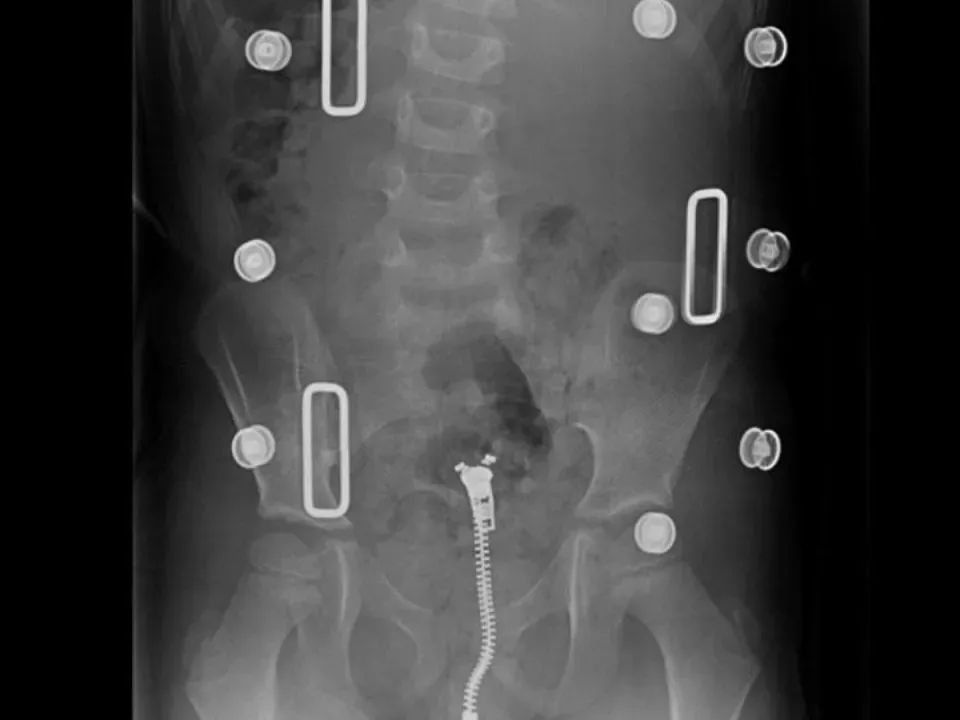 Scoliosis orthotic and bracing consultation at DakshinRehab, Moosapet, Hyderabad