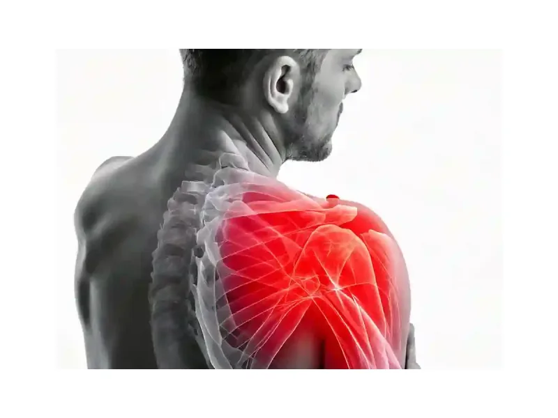 Shoulder impingement — pinching of tendons in the subacromial space
