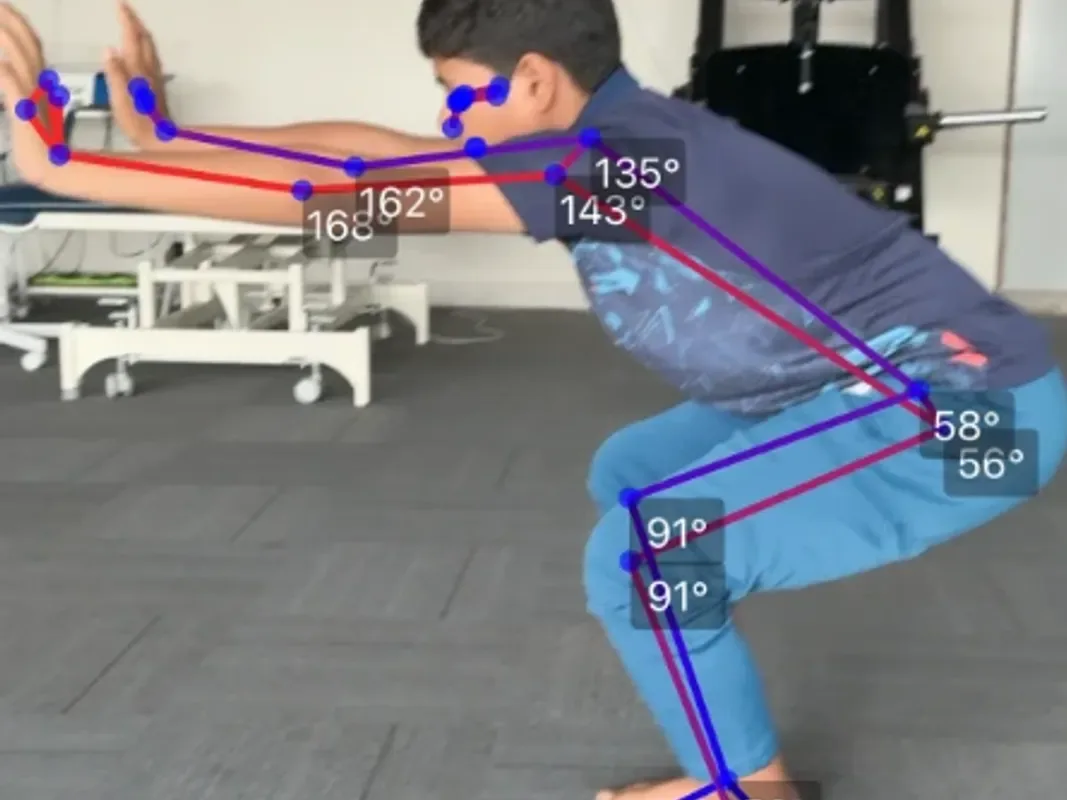 3D posture analysis for scoliosis-related posture
