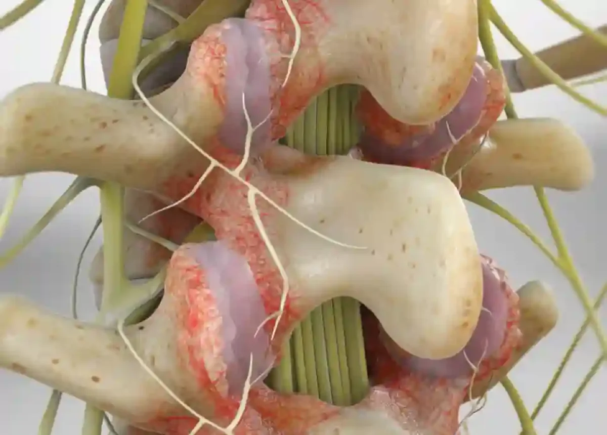 Facet Joint Syndrome