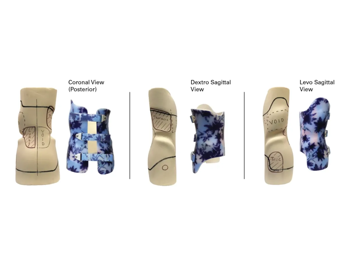 Orthotist cast rectification for a custom scoliosis brace