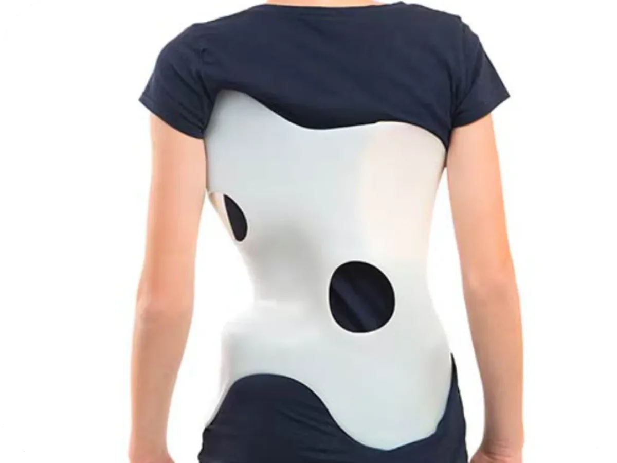 Young girl fitted with a custom scoliosis brace at DakshinRehab, Moosapet, Hyderabad