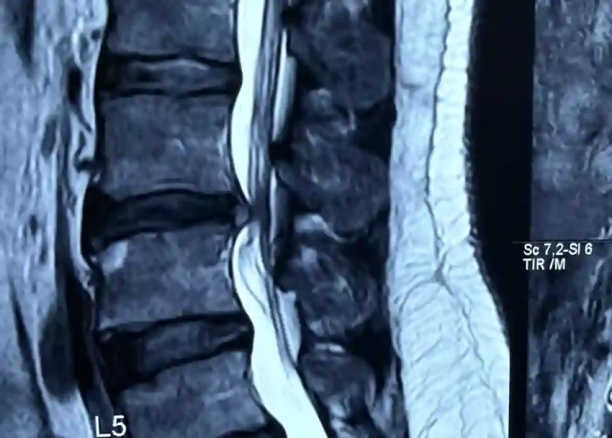 Lumbar disc herniation treatment with spinal decompression at DakshinRehab