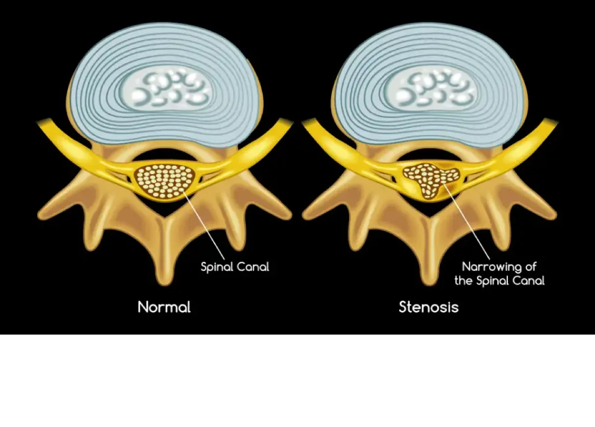 Spinal Stenosis