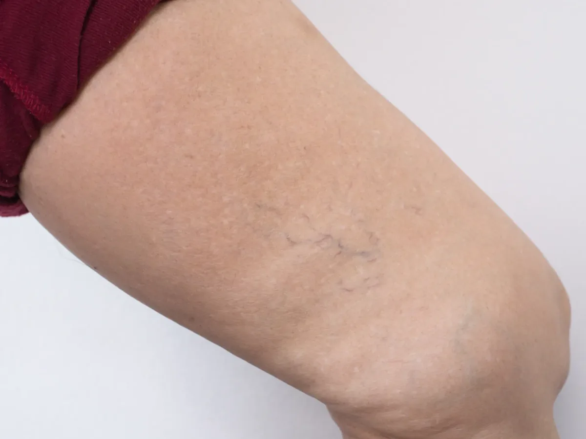 MLD for venous insufficiency