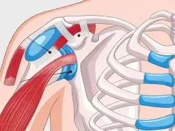 Shoulder impingement syndrome physiotherapy at DakshinRehab Moosapet