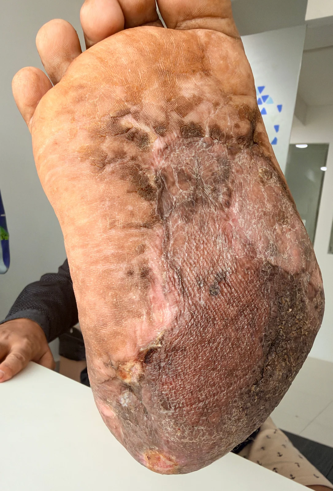 Clinic-supplied follow-up photograph of the sole and heel