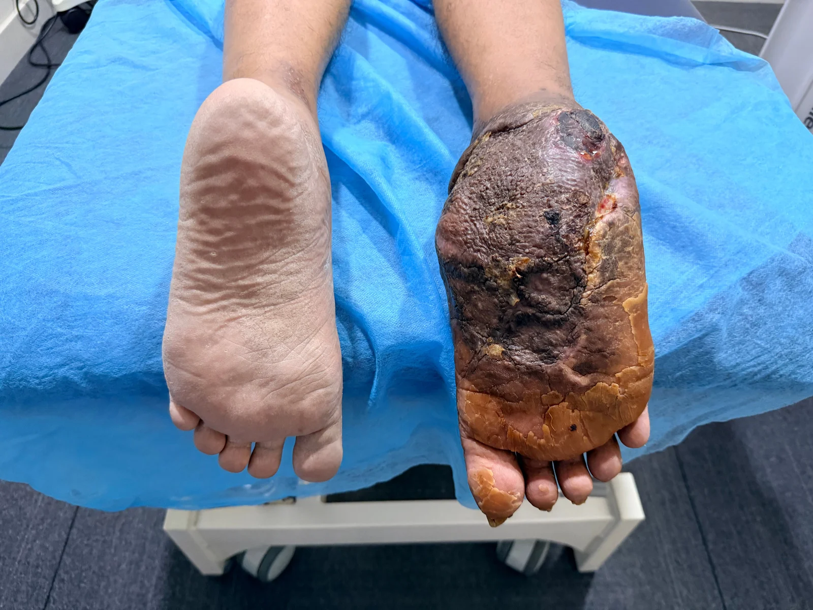 Clinic-supplied initial wound photograph of the sole and heel