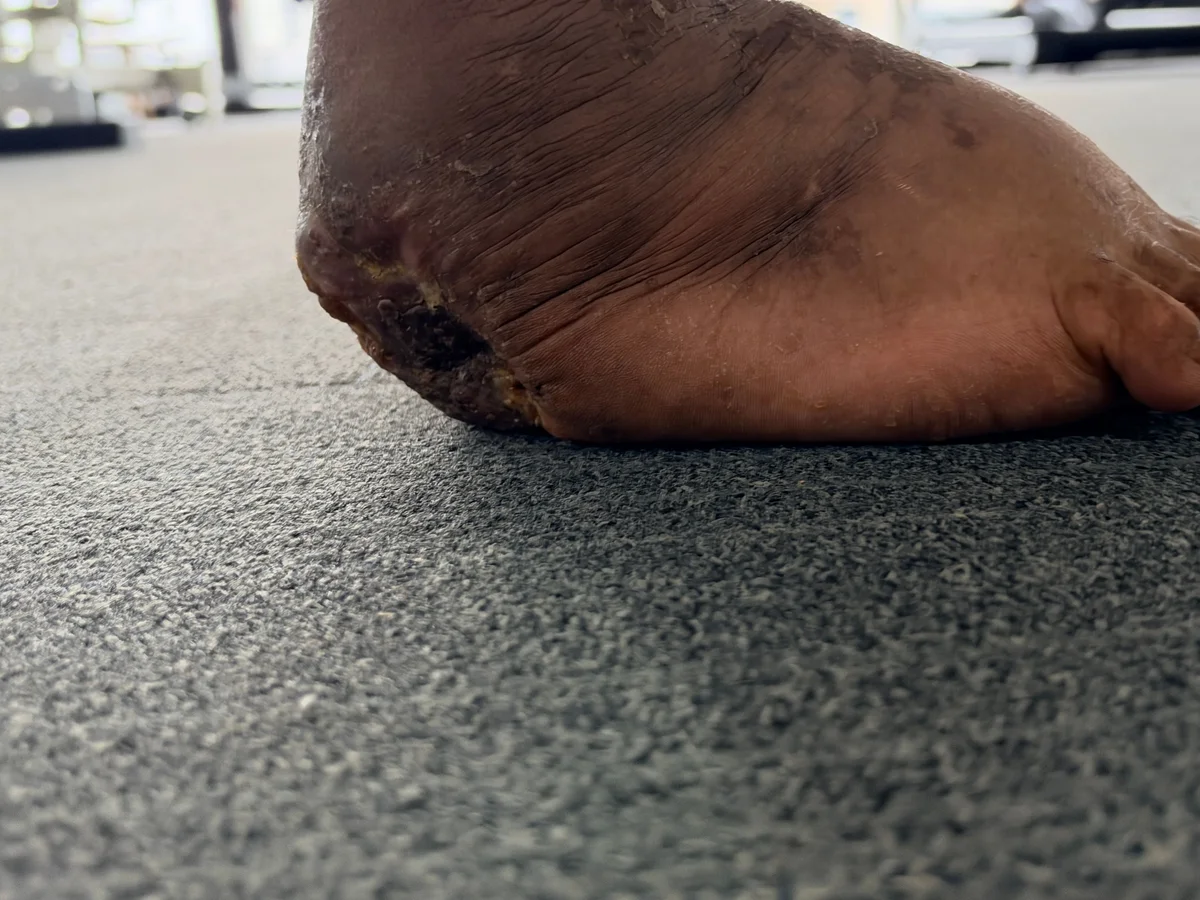 Clinic photograph of foot position on the floor; daily activity must follow the treating team’s restrictions
